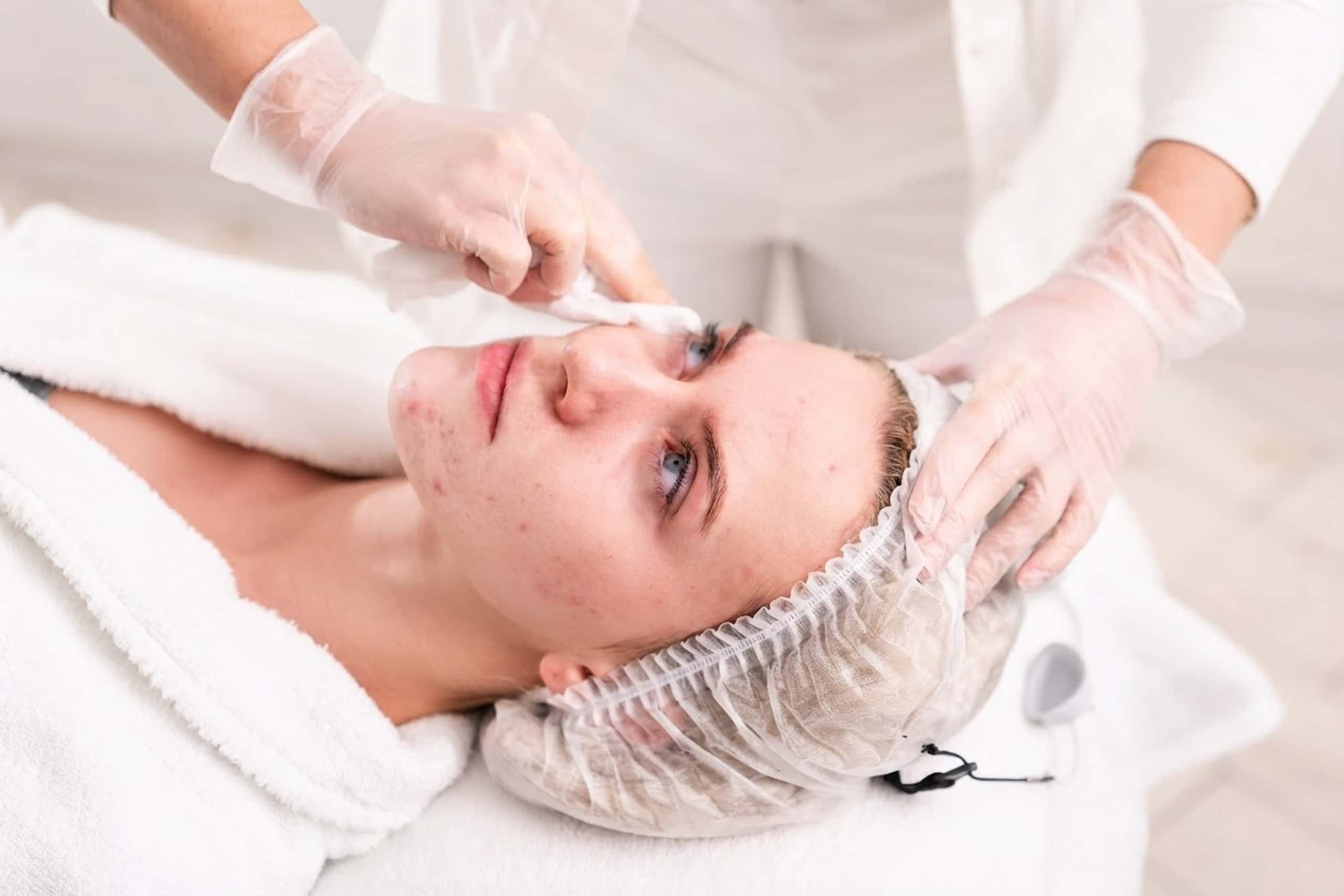 Acne Treatment at A.Maks Aesthetics Med Spa