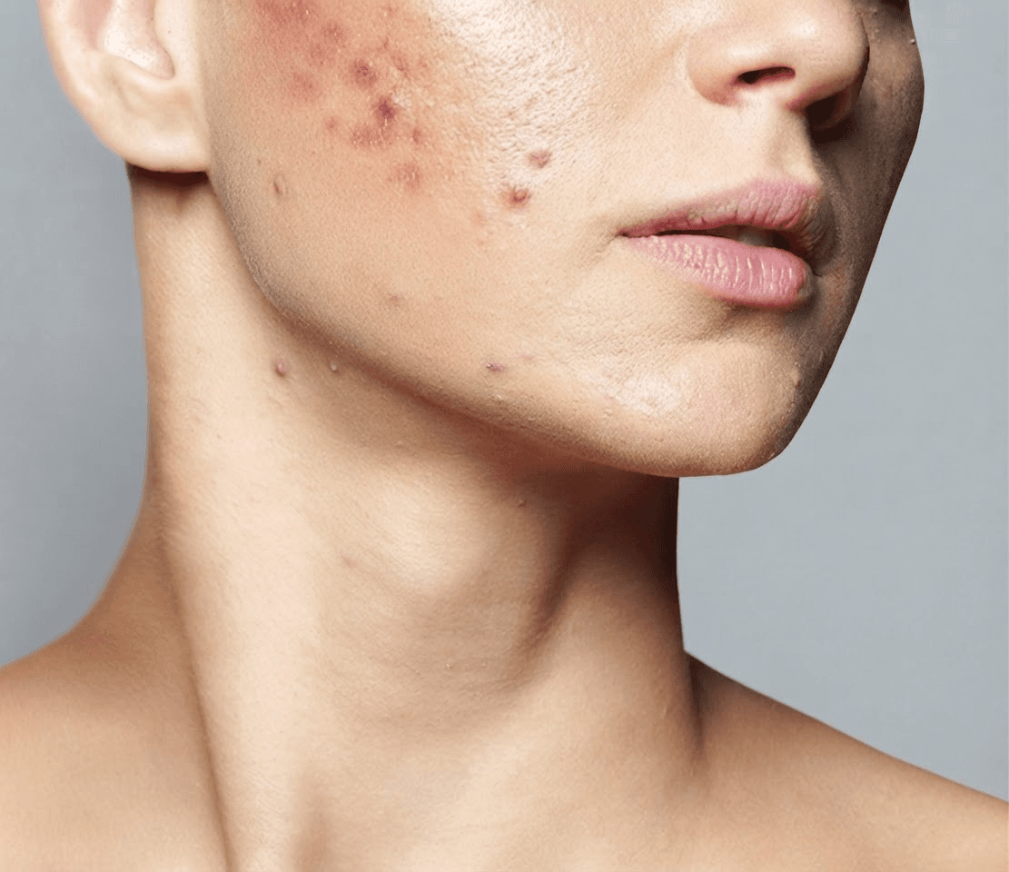 Laser Resurfacing — after, patient 3