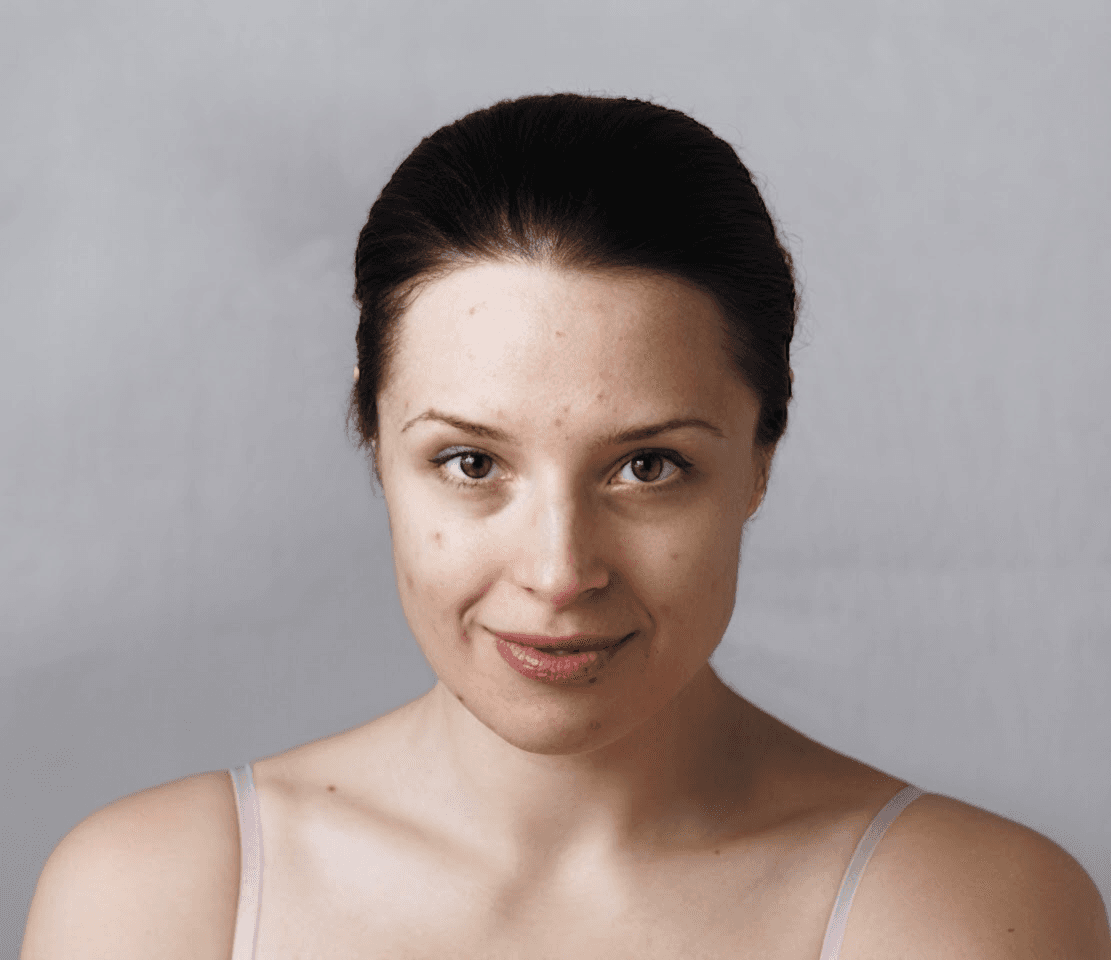 Laser Resurfacing — before, patient 2